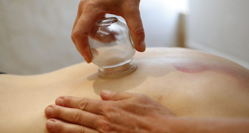 Traditional chinese medecine. Cupping therapy. Woman receving fi