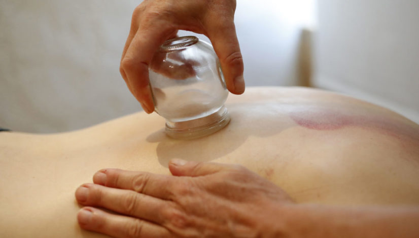 Traditional chinese medecine. Cupping therapy. Woman receving fi