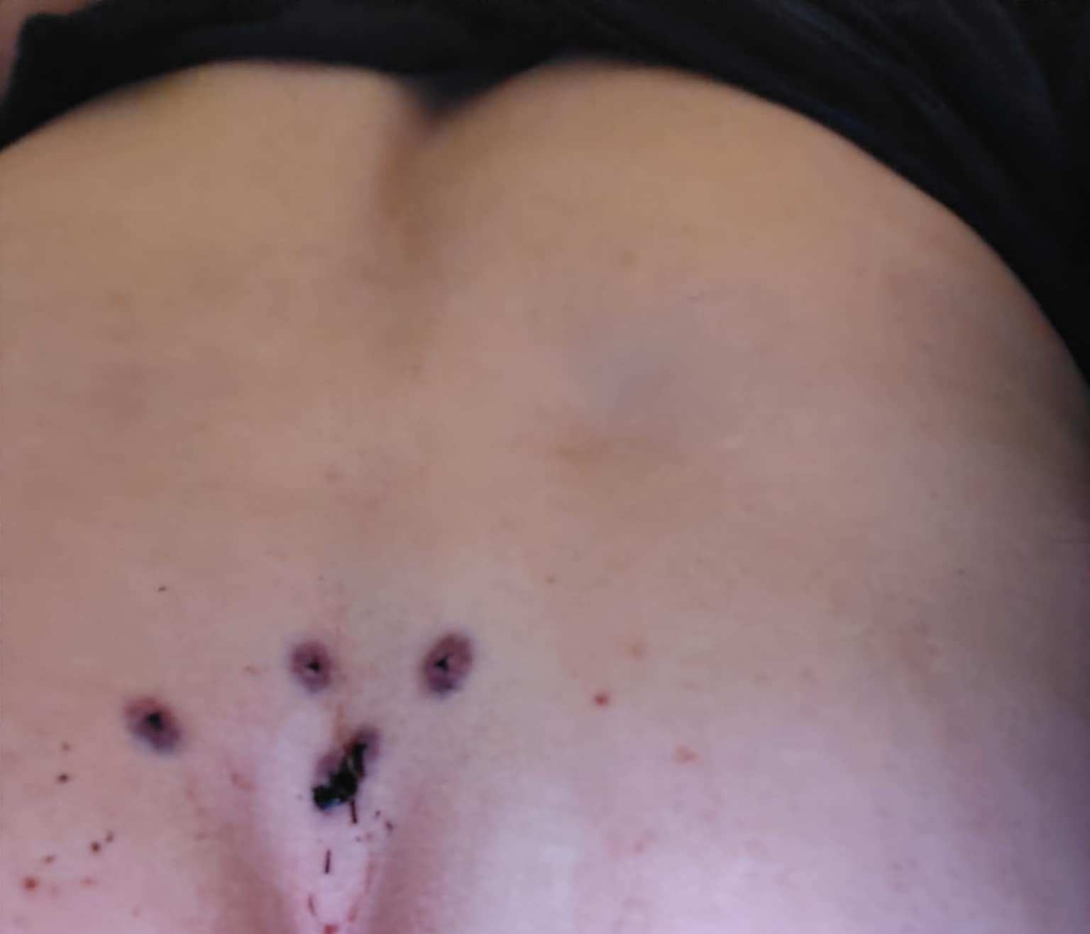 Zdjęcie 4. Stan ran 24 godziny po zabieguŹródło: Archiwum prywatnej praktyki pielęgniarskiej 